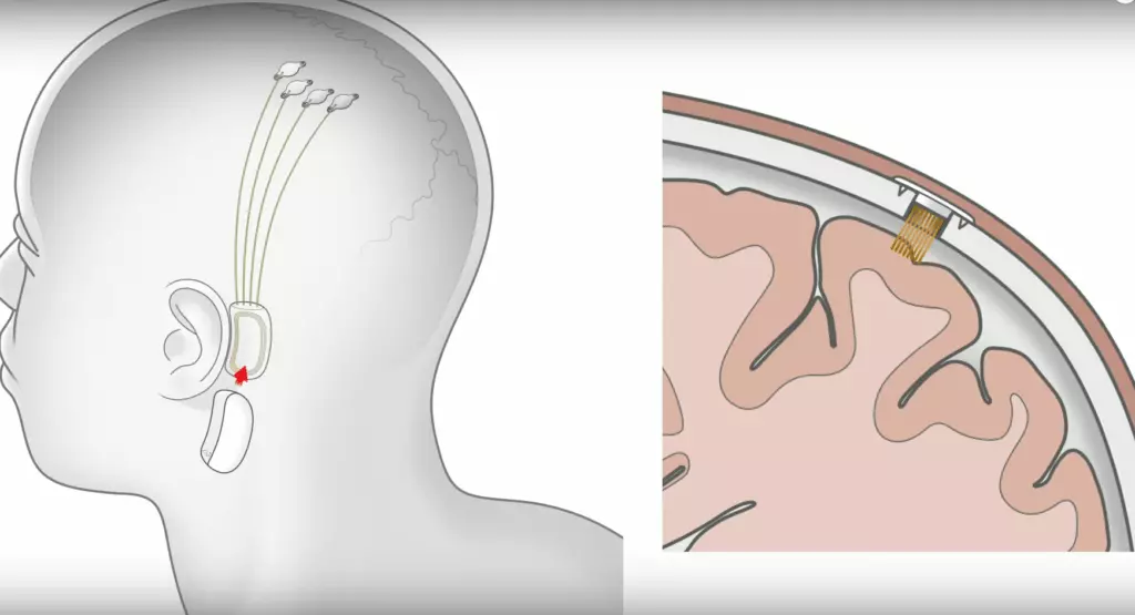 Neuralink pose d'un implant Cerveau-machine